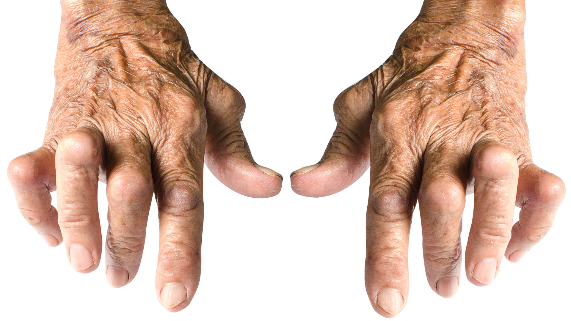 artritis en las manos